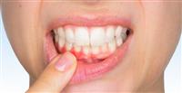 Diş Eti Hastalığı Nasıl Tedavi Edilir